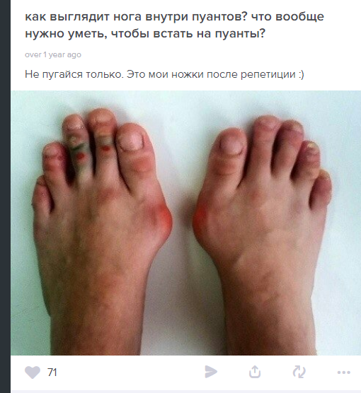 510x556, 289 Kb / балерина, пуанты, уродство, ноги