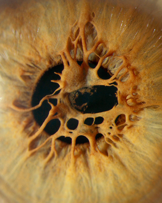 640x800, 268 Kb / радужка, зрачок, отклонение