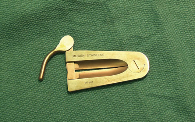 640x400, 81 Kb / фимоз, обрезание