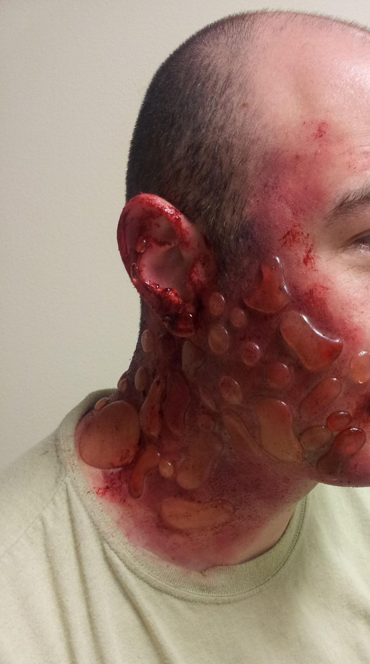 1280x2297, 256 Kb / ожог, волдырь, актёр, бутафория