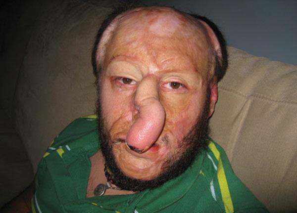 600x431, 28 Kb / ожог, пересадка