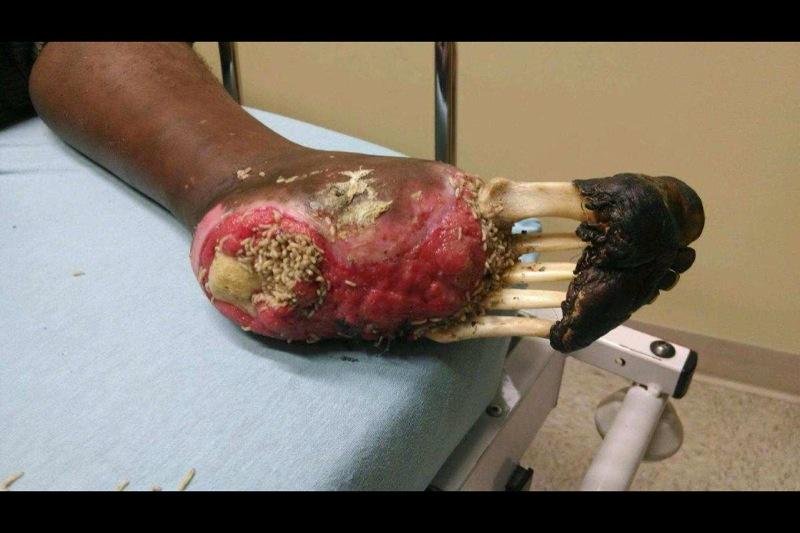 800x533, 64 Kb / нога, рана, кость, стопа, личинки