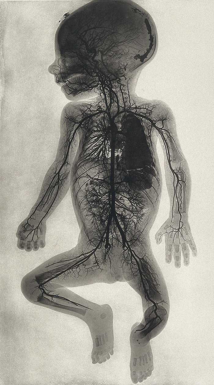 700x1258, 345 Kb / младенец, снимок, МРТ, сосуды